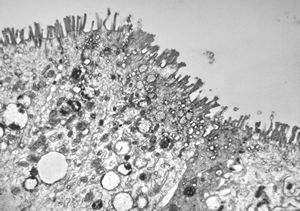 celiakia celiakia
